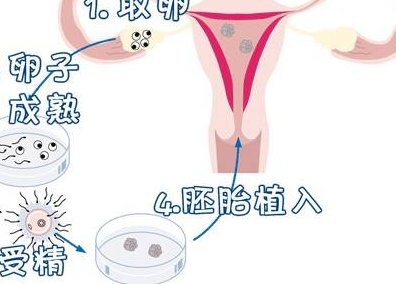 在吉尔吉斯斯坦进行试管婴儿治疗的费用及医院技术情况分析